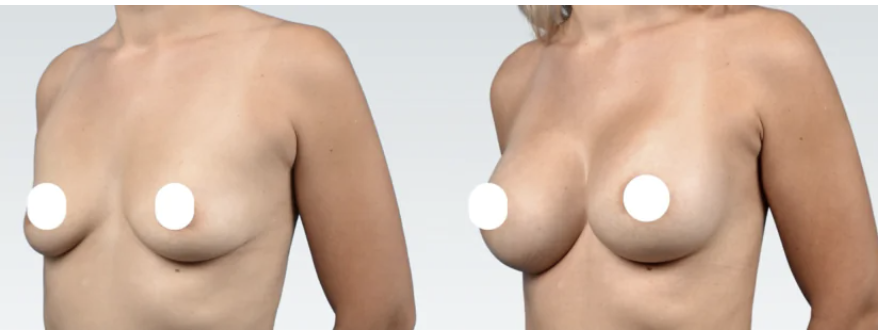Cold Subfascial Breast Augmentation